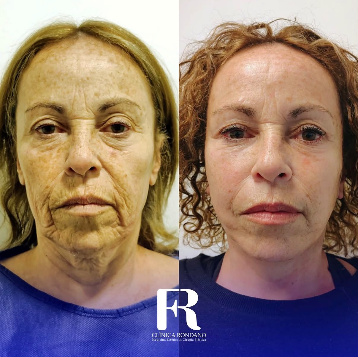 Lifting Facial — Deep Plane — antes
