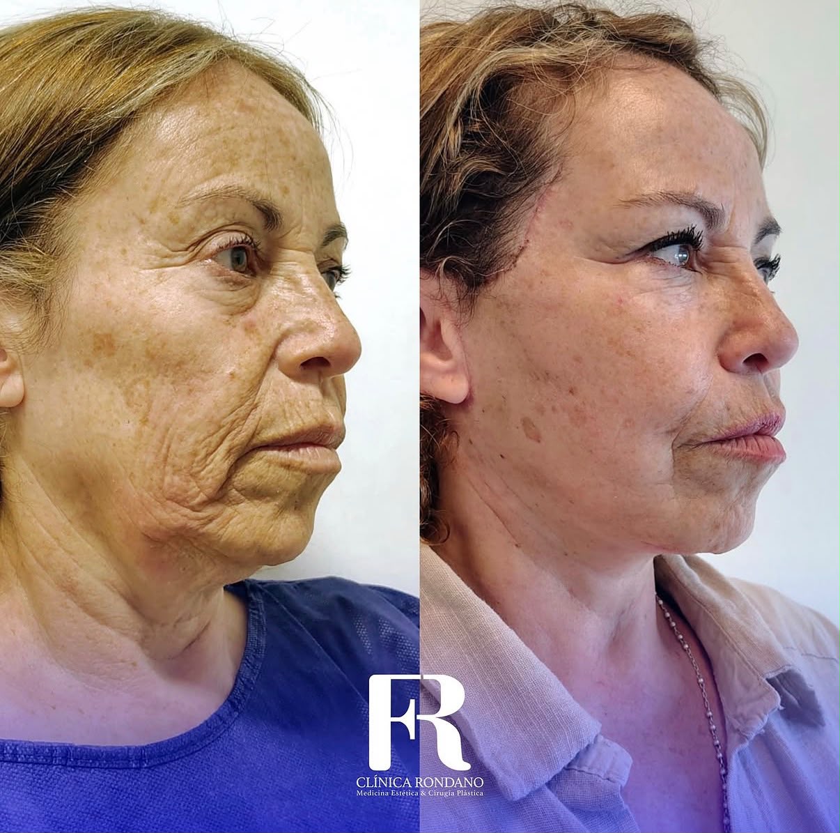 Lifting Facial — Deep Plane — después